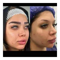 جشنواره کاشت مو و ابرو تا یک هفته ژل بوتاکس