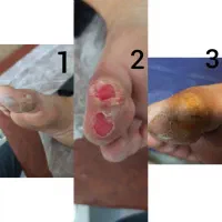 درمان تضمینی و تخصصی زخم در منزل|خدمات آرایشگری و زیبایی|تهران, نظامی گنجوی (توانیر)|دیوار