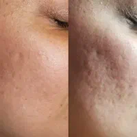 آموزش فیشال آلگاپیل(پوست مار) همراه با مدرک|خدمات آرایشگری و زیبایی|شیراز, معالی‌آباد|دیوار