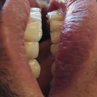 تخفیفات نوروز ایمپلنت قسطی