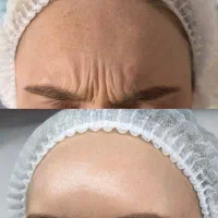 بوتاکس،فیلر، ژل ،ریموو تتو|خدمات زیبایی و سلامت|کرمانشاه, |دیوار