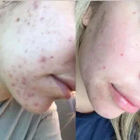 فشیال درمانی و پاکسازی با 50% تخفیف|خدمات زیبایی و سلامت|تهران, بنیهاشم|دیوار