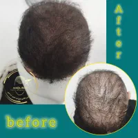 میکرواسکالپ رشد مجدد مو|خدمات آرایشگری و زیبایی|رشت, بوسار|دیوار