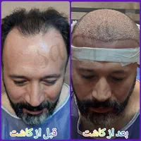 پیوند مو و ابرو در تهران در کلینیک معتبر