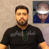 کاشت مو با تراکم بالا فقط با ۸ میلیون پیش‌پرداخت|خدمات آرایشگری و زیبایی|تهران, جردن|دیوار