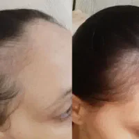 سرم رویش مجدداکسونیک.