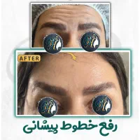 تزریق تخصصی بوتاکس صورت توسط پزشک، مطب زیبایی رشت|خدمات آرایشگری و زیبایی|رشت, گلسار|دیوار