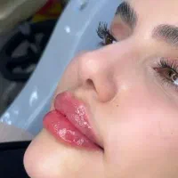 تزریق‌ژل فیلر لب گونه چانه زاویه بادی