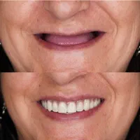 وام دندانپزشکی ایمپلنت