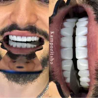 فقط تا ۲۴ ساعت با۱۹۹۰۰ هرفک کامپوزیت کن تو ساری