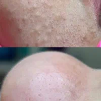 مدل جهت پاکسازی پوست درمان جوش،لک،آبرسانی|خدمات آرایشگری و زیبایی|آبادان, |دیوار