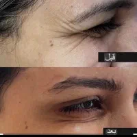 بوتاکس مصپورت  فول فیس۶۰۰تومان
