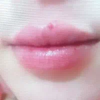 فیلر و بوتاکس