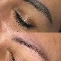 ریموو تتو در یک جلسه
