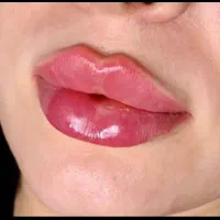 مدل  ژل وبوتاکس