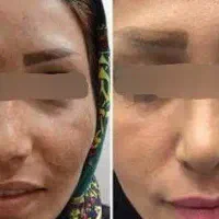 پک ضد لک فوق حرفه ای