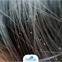 پاکسازی آنی و تضمینی مو از رشک و شپش با دستگاه