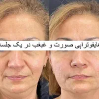 تخصص ما لیزر ژل و بوتاکس حرفه ای و جوانسازی پوست|خدمات آرایشگری و زیبایی|تهران, شهرک ولیعصر جنوبی|دیوار