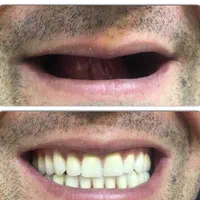 ساخت و تعمیر انواع دندان مصنوعی(به صورت اقساط )|خدمات آرایشگری و زیبایی|یزد, |دیوار