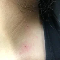 حذف انواع خال (گوشتی،سطحی،زیگیل)|خدمات آرایشگری و زیبایی|کاشان, فاز ۲ ناجی آباد|دیوار