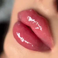 آف تزریق ژل وبوتاکس تاآخرهفته فقط