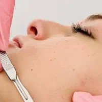 درماپلینگ فرصتی برای داشتن پوست زیبا و درخشان