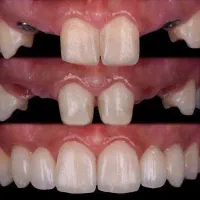 ایمپلنت با روکش هدیه 12.600 محدود|خدمات آرایشگری و زیبایی|تهران, ستارخان|دیوار