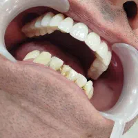 ایمپلنت اقساطی