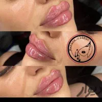 تزریق بوتاکس،فیلر(ژل)،مزوتراپی و در کلینیک ماهانا