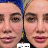 بلفاروپلاستی پلک بدون جراحی