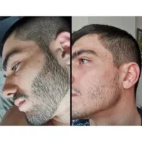 خداحافظی با جاهای خالی صورتت
