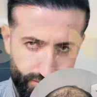 جشنواره کاشت مو و ابرو با تخفیف ویژه|خدمات آرایشگری و زیبایی|تهران, نیاوران|دیوار