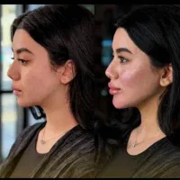 آموزش تزریق فیلر و بوتاکس آنلاین و حضوری