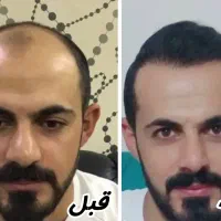 کاشت مو بصورت فول تراکم با شرایط ویژه