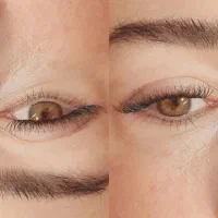 کاشت هیدن تک لاین 110