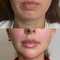 تزریقات زیبایی