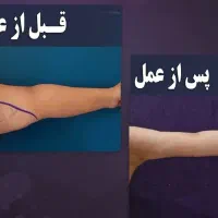 *آخرین تخفیف*عمل لیپو و ابدو و پیکرتراشی و لیفت|خدمات آرایشگری و زیبایی|کرج, گلشهر|دیوار