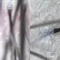 اسکالپ سر و پاکسازی پوست