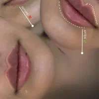 تخفیفات ژل و بوتاکس جوانساز توسط شخص دکترچابکی|خدمات زیبایی و سلامت|قم, هفت تیر|دیوار
