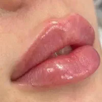 مزو،بوتاکس،چربی،فیلر،جراحی زیبایی صورت وبدن|خدمات آرایشگری و زیبایی|تهران, نارمک|دیوار