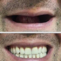 ساخت دست دندان متحرک با بهترین مواد و شرایط اقساط