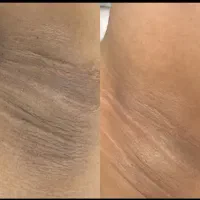 فیلربادی۱۰۰سیسی۱۱تومن باسن هیپ دیپ وآموزش فقط ۷۹۰۰|خدمات آرایشگری و زیبایی|کرج, گوهردشت|دیوار