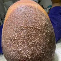 کاشت مو فول تراکم حتی بانک موی ضعیف