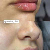 آموزش فیلر،بوتاکس،مزو،مزو ژل با مدرک|خدمات آموزشی|آبادان, |دیوار