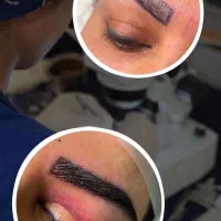 تخفیف ویژه کاشت مو و کاشت ابرو