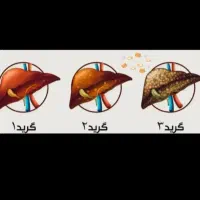 بهبودی کبدچرب صد در صد تضمینی