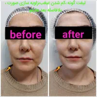 جشنواره  تابستانه ی هایفو ۷ بعدی فقط به مدت ۱۰ روز|خدمات آرایشگری و زیبایی|تهران, آسمان|دیوار