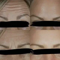 تزریق ژل و بوتاکس|خدمات آرایشگری و زیبایی|اهواز, کوروش|دیوار