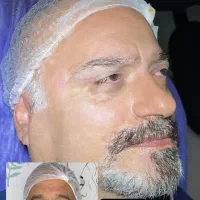 تخفیف ویژه عمل افتادگی پلک بلفاروپلاستی نقدو اقساط|خدمات آرایشگری و زیبایی|تهران, تهرانسر مرکزی|دیوار