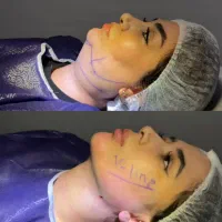 سوپرکانتورینگ‌زاویه‌فک و چانه